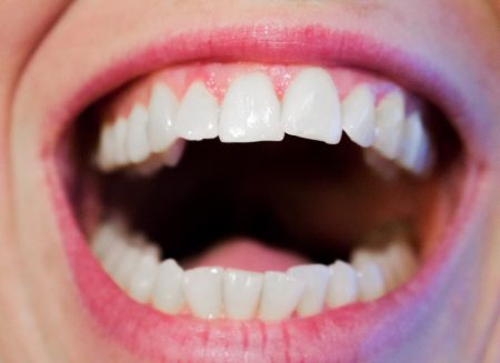 What's The Difference Between An Infected Tooth And An Impacted Tooth?